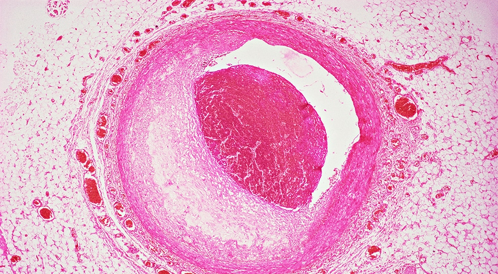 Le rôle du microbiote intestinal dans le développement de maladies cardiovasculaires